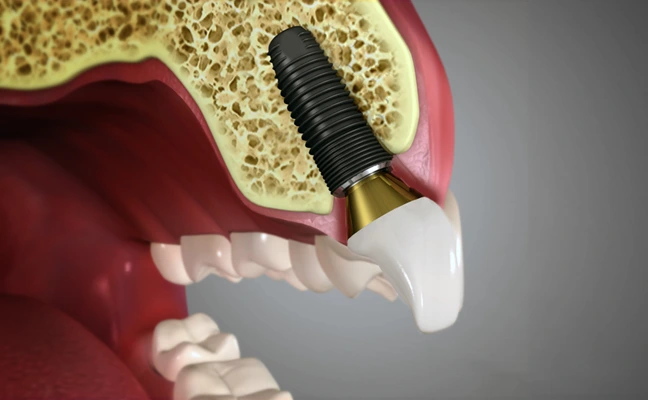 Dental Implants in Key West Florida