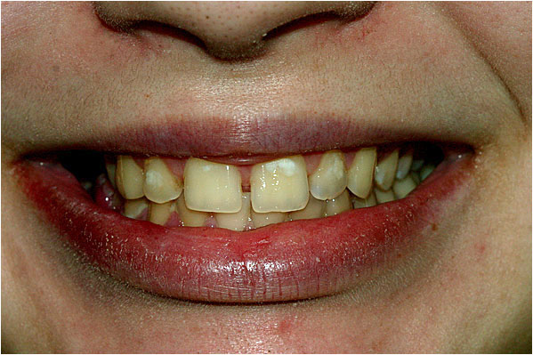 Dental Veneers Before