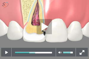 tooth colored fillings - Class III